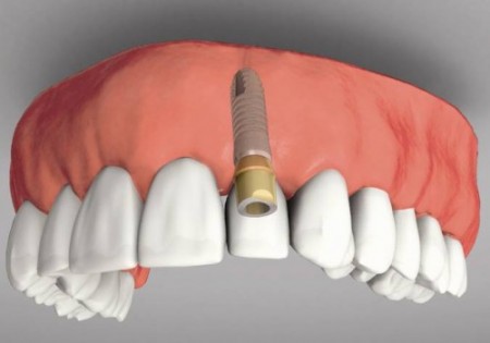 Trồng răng khi bị mất một răng Ky-thuat-trong-rang-implant-1-450x315