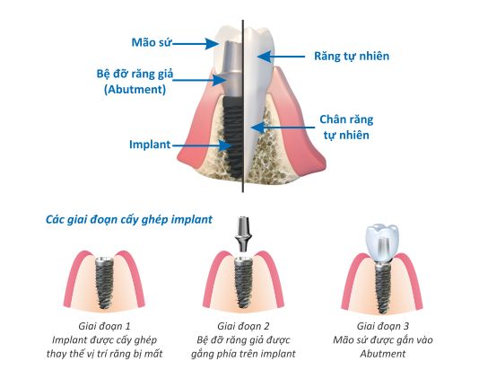 Trồng răng implant Trong-rang-implant-1