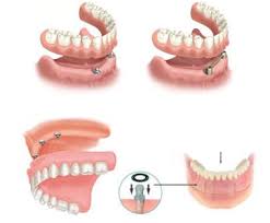 Trồng răng implant có nguy hiểm không ? Trong-rang-implant-co-nguy-hiem-gi-khong-1