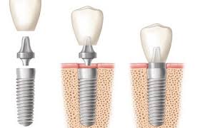 Trồng răng implant có nguy hiểm không ? Trong-rang-implant-co-nguy-hiem-gi-khong