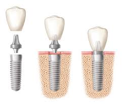 Răng sứ sự lựa chọn để thẩm mỹ hàm răng Rang-su-su-lua-chon-de-tham-my-ham-rang-1