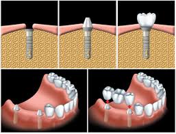 Trồng răng hoàn hảo với implant nha khoa Trong-rang-hoan-hao-voi-implant-nha-khoa-1