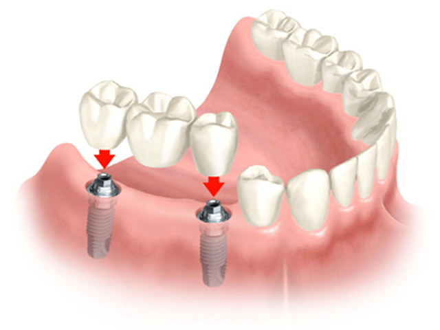 Trồng răng hoàn hảo với implant nha khoa Trong-rang-hoan-hao-voi-implant-nha-khoa