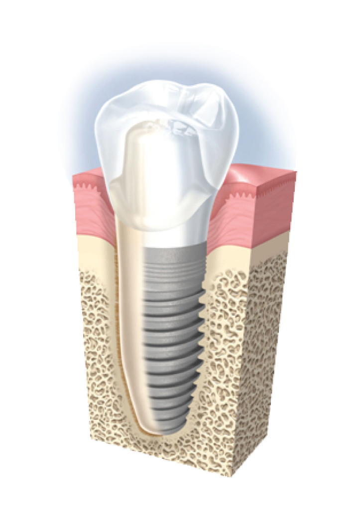 Vì sao trồng răng Implant lại có giá cao? Vi-sao-trong-rang-implant-lai-co-gia-cao-1