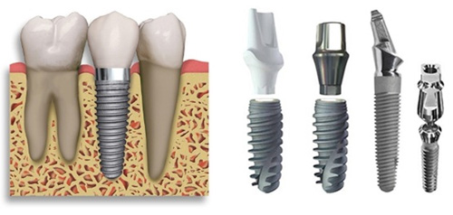 Vì sao trồng răng Implant lại có giá cao? Vi-sao-trong-rang-implant-lai-co-gia-cao-3