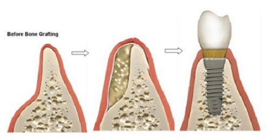 Trồng implant khi bị tiêu xương hàm Trong-implant-khi-bi-tieu-xuong-ham-1