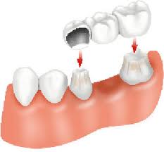 Những lý do để tạo ra răng sứ thẩm mỹ Boc-su-cho-rang-sau