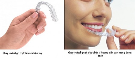 So sánh niềng răng mắc cài tự đóng và invisalign  So-sanh-nieng-rang-mac-cai-tu-dong-va-invisalign-01-450x193