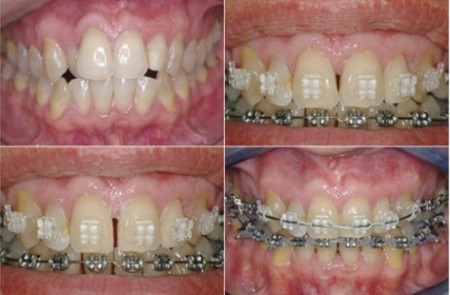 Cách khắc phục khớp cắn hở khi răng bị hô Cach-khac-phuc-khop-can-ho-khi-rang-bi-ho-450x295