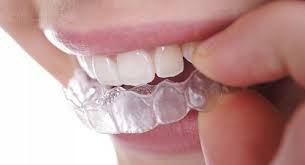 Sử dụng khay nhựa để điều trị niềng răng Su-dung-khay-nhua-de-dieu-tri-nieng-rang-1