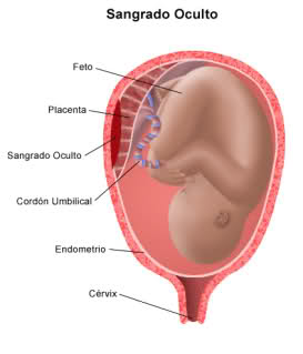 desprendimiento de placenta 2e1rqmf