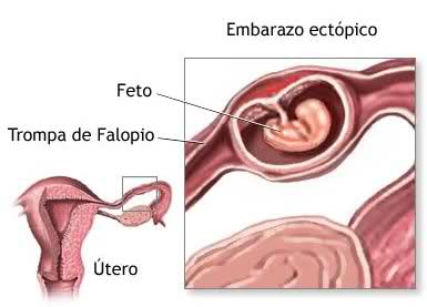 Embarazo Ectópico..que es..? 2rxi7nk