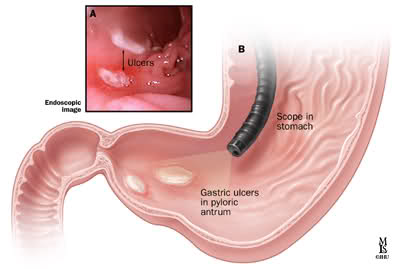 ملف كامل عن جرثومة المعدة بالصور F0zuz6