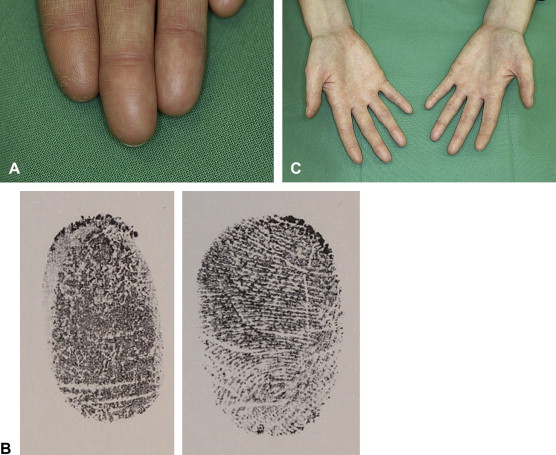 ADERMATOGLYPHIA - Inborn missing fingerprints is caused by a genetic defect! 1-s2.0-S0190962209014753-gr1