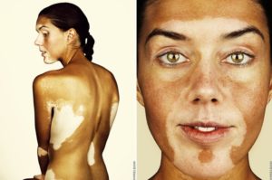 25 MART 2018 PAZAR BULMACASI SAYI : 1669 - Sayfa 2 Vitiligo-300x199