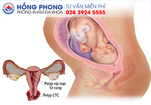 Điều gì có thể gây ra polyp tử cung Thai%20ph%E1%BB%A5%20m%E1%BA%AFc%20b%E1%BB%87nh%20polyps%20c%E1%BB%95%20t%E1%BB%AD%20cung%20th%C3%AC%20nguy%20c%C6%A1%20s%E1%BA%A3y%20thai%20r%E1%BA%A5t%20cao