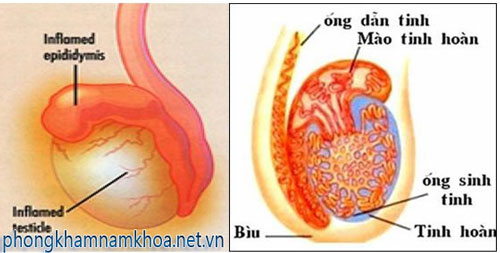 Viêm mào tinh hoàn là bệnh gì? Viem-mao-tinh-hoan-nguyen-nhan-do-dau