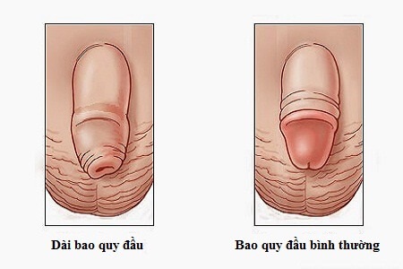 Toàn quốc - Dài bao quy đầu là như thế nào? Bao quy đầu dài có nên cắt không? Nhung-tac-hai-cua-benh-dai-bao-quy-dau