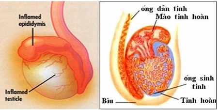 Chăm sóc sức khoẻ: Triệu chứng bị đau dịch hoàn ở nam giới là bệnh gì? Bi-dau-tinh-hoan-la-gi