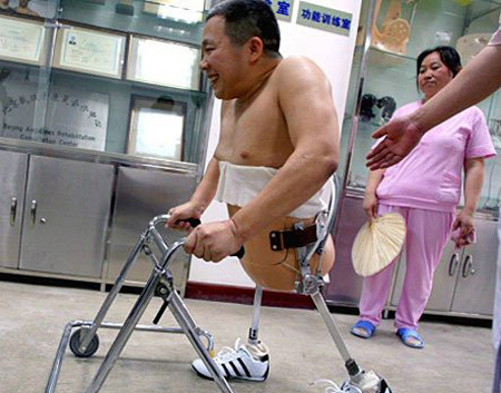 رجل صيني يعيش بنصف جسد منذ 10 سنوات  791362219