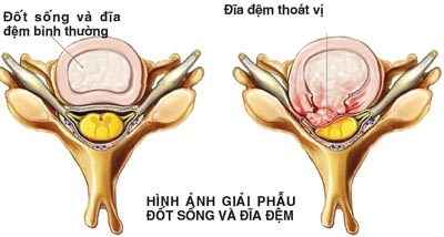 Các điều  cần  lưu ý  lúc bị  bệnh Thoát vị đĩa đệm Thoat_vi_dia_dem_cot_song_