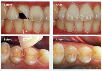 Làm răng sứ thẩm mỹ Lam-rang-su-tham-my