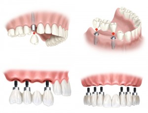 Những điều cần biết về trồng răng thẩm mỹ cố định Trong-rang-co-dinh-300x229