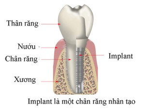 Những điều cần biết về Implant răng Cham-soc-Implan-02-300x228