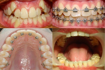 Tốc độ di chuyển của răng khi niềng răng Toc-do-di-chuyen-khi-nieng-rang-1