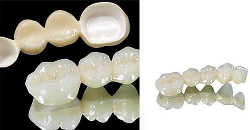 Những loại răng sứ để trồng răng Nhung-loai-rang-su-de-trong-rang