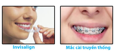 Điểm qua những ưu điểm nổi bật của phương pháp invisalign Diem-qua-nhung-uu-diem-noi-bat-cua-phuong-phap-nieng-rang-invisalign-2-450x199