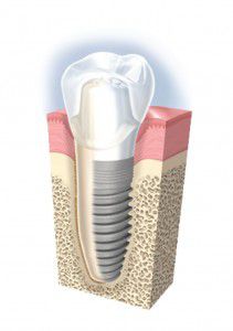 Vì sao trồng răng sứ Implant lại có giá thành cao ? Vi-sao-trong-rang-su-Implant-lai-co-gia-thanh-cao-1-211x300