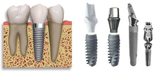 Vì sao trồng răng sứ Implant lại có giá thành cao ? Vi-sao-trong-rang-su-Implant-lai-co-gia-thanh-cao-3