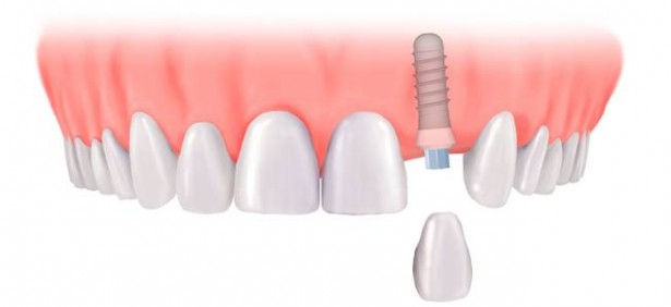 Thông tin chung về trồng răng sứ bằng cấy ghép Implant Thong-tin-chung-ve-trong-rang-su-bang-cay-ghep-implant-2