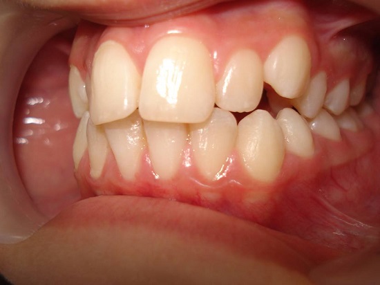 Khi nào phải dùng thêm mini vit hỗ trợ niềng răng ? Khi-nao-phai-dung-them-mini-vit-ho-tro-nieng-rang-1