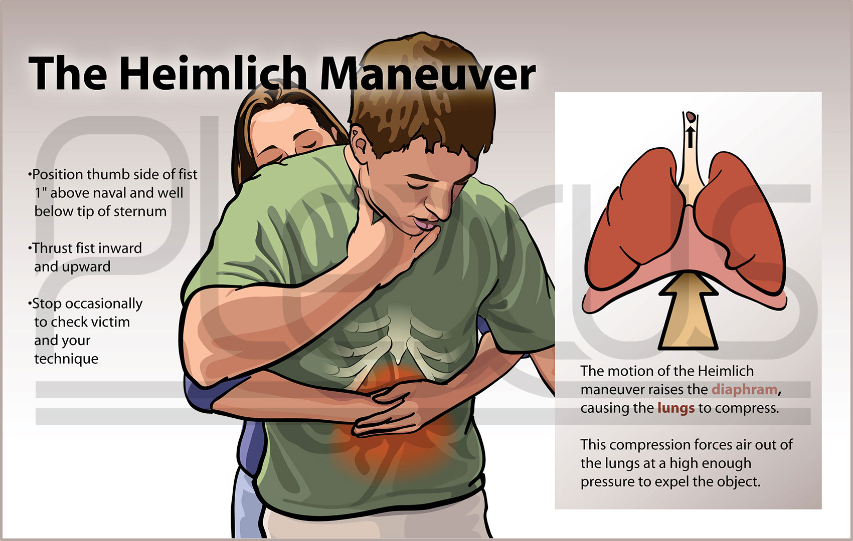 كيف تساعد من يتعرض الى الاختناق ؟ طريقة هايملخ 2002_Heimlich_Illustrator_Watermark