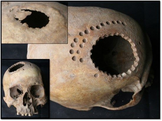 Los primeros neurocirujanos de América Experimento-trepanacion-post-morte