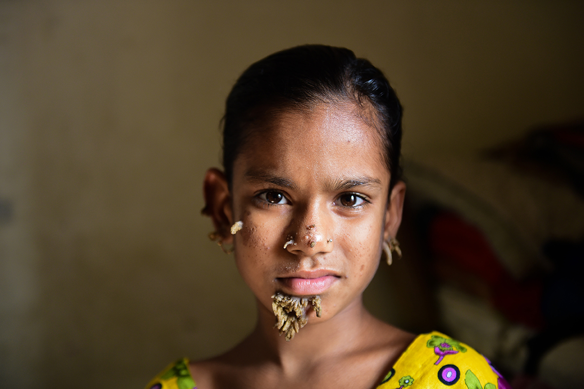 Premier cas mondial de "femme-arbre" au Bangladesh 15877542