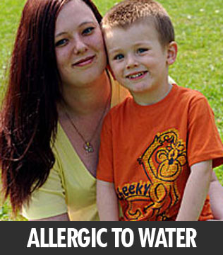 Semundjet me te cuditeshme ne bote.. 767776-woman-allergic-to-water