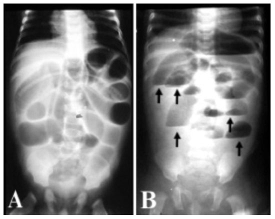 OBSTRUÇÃO INTESTINAL A8n1a02-fig13