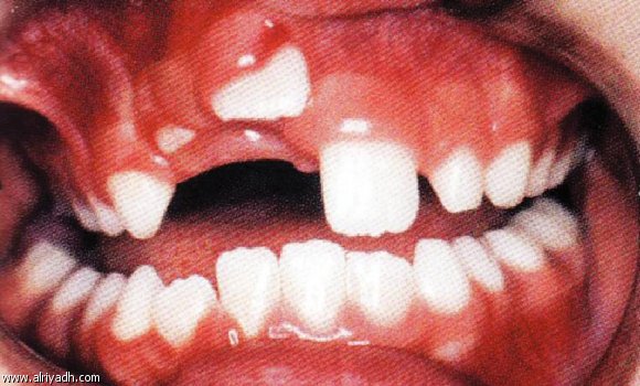 إصابات الأسنان تؤثر على نفسية الطفل مستقبلاً .. 196009