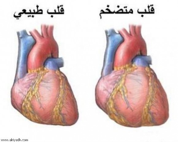 أمراض القلب الخلقية ومتلازمة داون 545410018213