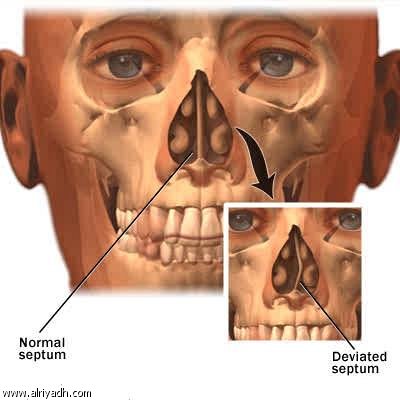 80% من الأشخاص يعانون من انحراف الوتيرة الأنفية 014346553932