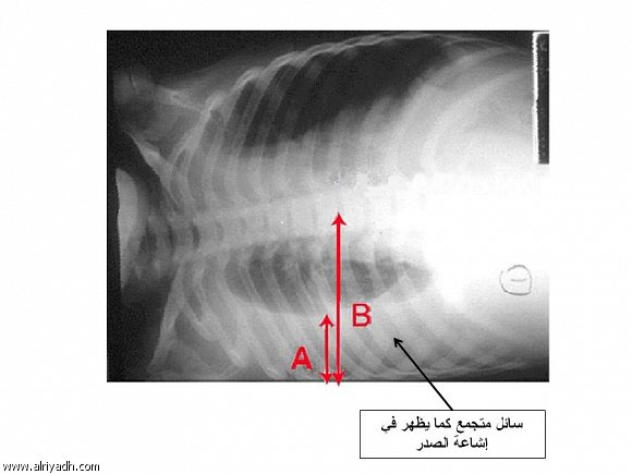 فشل القلب أكثر الأسباب شيوعاً لتجمع السوائل داخل التجويف البلوري 634527092916