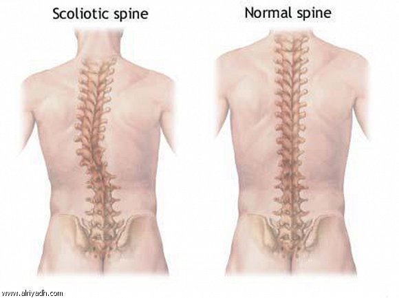 معالجة انحراف العمود الفقري التلقائي والخلع الولادي 804340673116