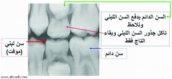 الفيتامينات والمعادن.. نقصهما يترك أثراً واضحاً علي أسنان الطفل منذ الصغر! 822284392263