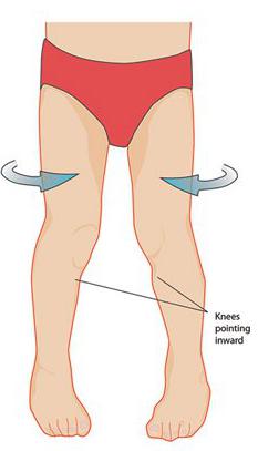 اعوجاج قدمي الطفل ... الغالبية العظمى تتحسن مع مرور الوقت ! 374804307925