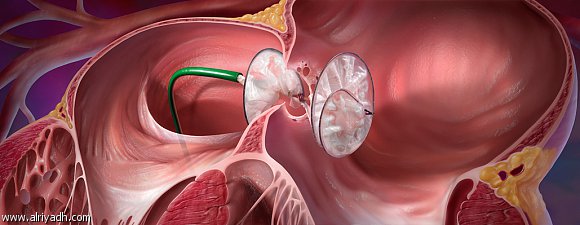 ثقب القلب.. أغلب الحالات ليس لها سبب واضح يمكن تفاديه 316596631084