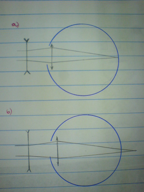 Defeitos da Visão Lentes