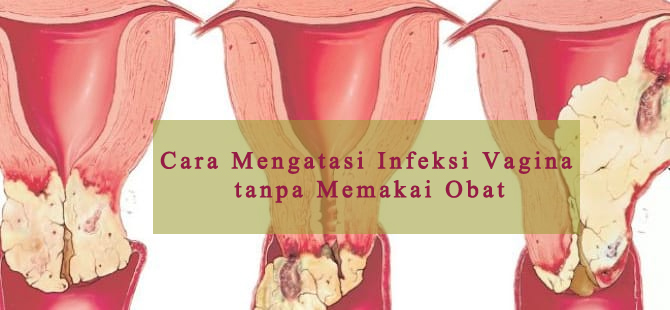 Cara Mengatasi Infeksi Vagina tanpa Memakai Obat Cara_Mengatasi_Infeksi_Vagina_tanpa_Memakai_Obat